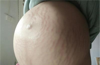 孕期如何防止妊娠纹