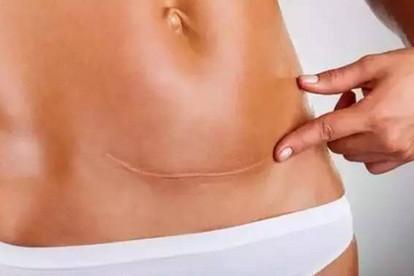 同样是剖腹产，明星肚子上的那条疤为何看不出！