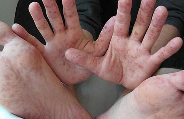 手足口病有什么症状