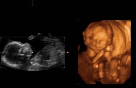 怀孕8个月胎儿b超图