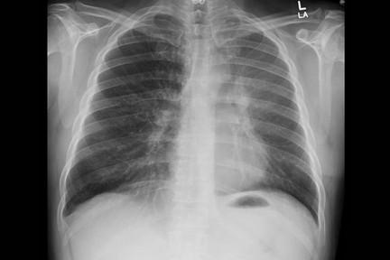 孩子要拍X光片？如何减少和理解X光辐射伤害