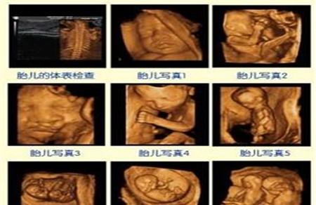 四维彩超检查什么