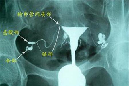 输卵管造影的副作用