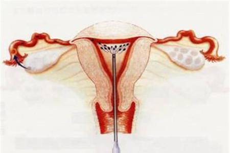 输卵管造影怎么做