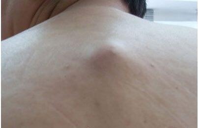 脂肪瘤的原因及治疗方法