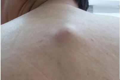 脂肪瘤的原因及治疗方法