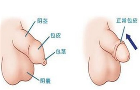 包茎手术最佳年龄