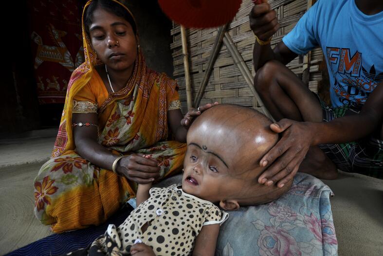 怎样预防小儿脑积水