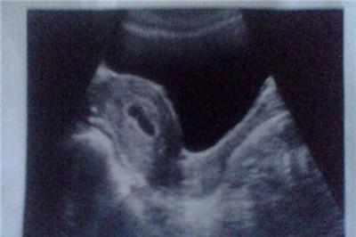 孕囊长条形就一定是男孩吗