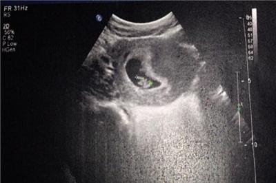 孕囊多大可以看见胎心胎芽