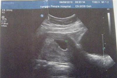 孕囊每天增长多少mm