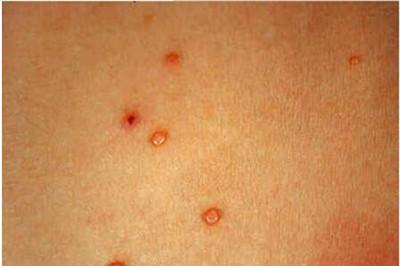 扁平疣偏方简单有效