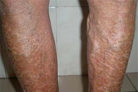 鱼鳞病长大后会好吗