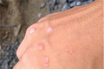 扁平疣爆发期多久消退