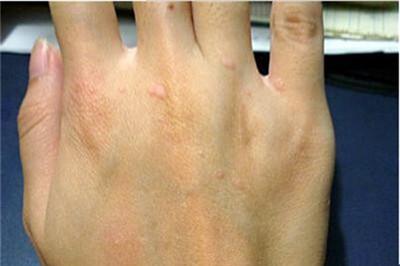 扁平疣会自己消失吗