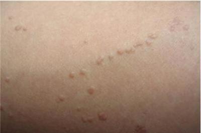 扁平疣的症状表现