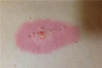 扁平疣艾灸能治愈吗