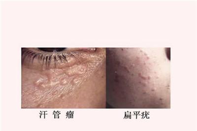 扁平疣和汗管瘤的区别