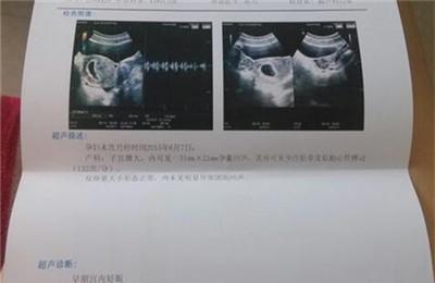 孕囊空囊是怎么回事