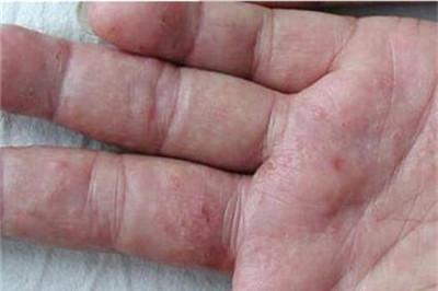 汗疱疹能自愈吗