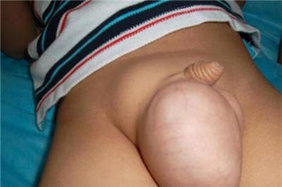 小儿腹股沟疝气位置图