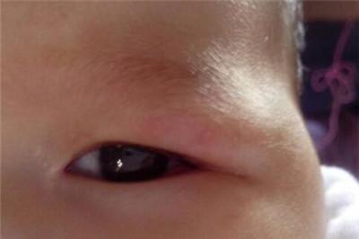 宝宝眼睛肿是怎么回事