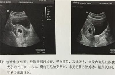 孕囊长条形正常吗