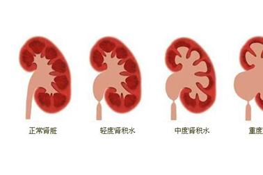 憋尿会引起肾积水吗