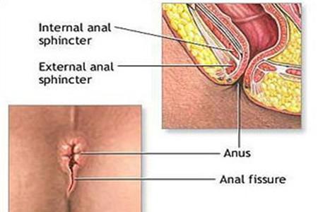 生完孩子肛裂怎么办