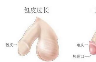宝宝包皮长，要不要一出生就割掉？