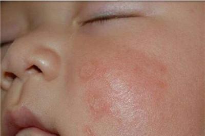 孩子三岁脸上有白斑怎么回事