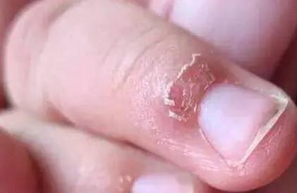 宝宝5个月就长倒刺，是缺什么吗？乱抠乱撕，后果很严重！