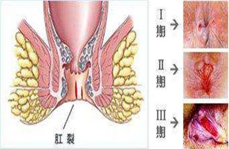 产后肛裂出血怎么办