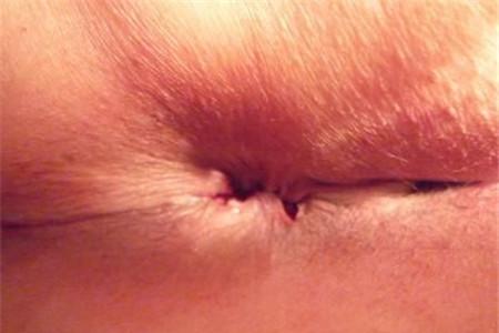 产后肛裂多久能好