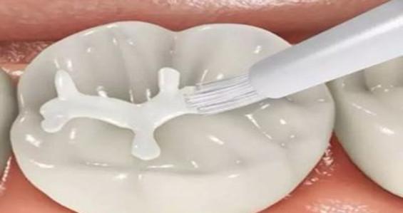 什么是窝沟封闭