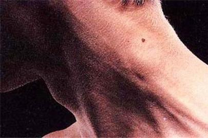 艾滋病初期淋巴结肿大图片