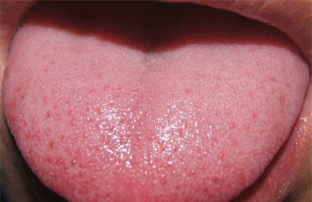 舌头上有红点是不是艾滋病