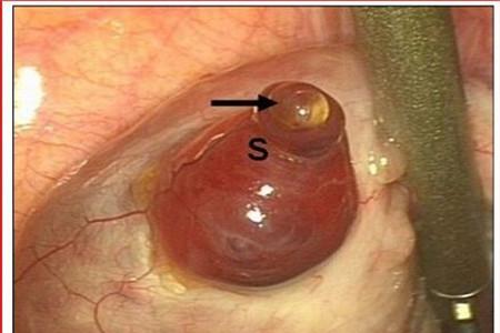 卵泡破了就是排卵吗