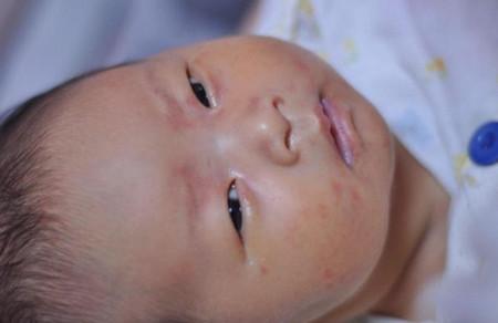 粟粒疹：新生宝宝脸上的小泡泡