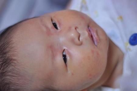 粟粒疹：新生宝宝脸上的小泡泡