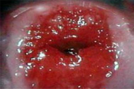 宫颈糜烂有什么症状图