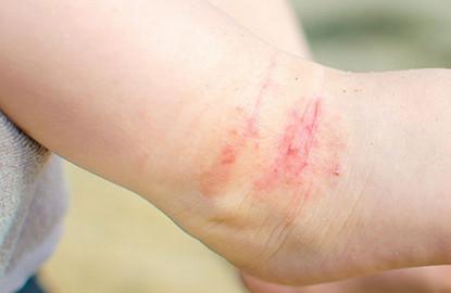 [医生来分享]治疗小儿异位性皮肤炎的六大心得