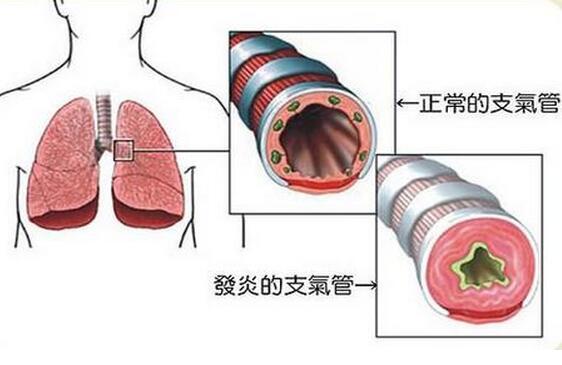 小儿急性支气管炎多久能好