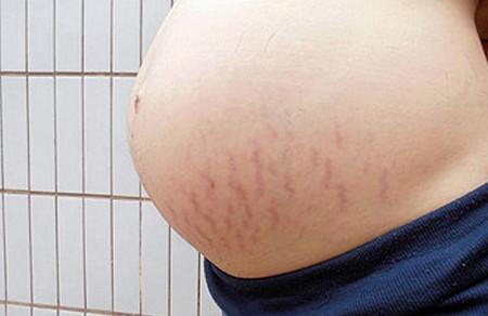 2个关键期把握好，轻松应对妊娠纹！收藏~