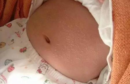 宝宝蜕皮，干性湿疹惹的祸？