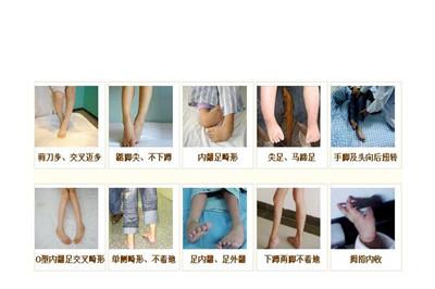 脑瘫宝宝姿势异常图
