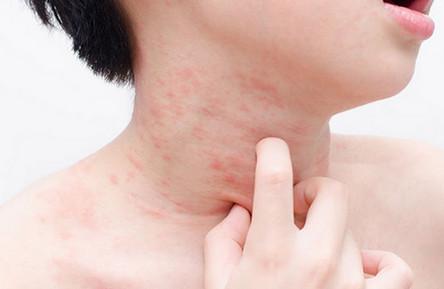 异位性孩童难入眠！医师：口服褪黑激素有效