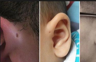 小孩子耳朵飘异味，耳朵上方「小洞」在作怪?