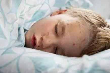 崔玉涛：最近中招率极高的荨麻疹、水痘、风疹，给你一次讲清楚！