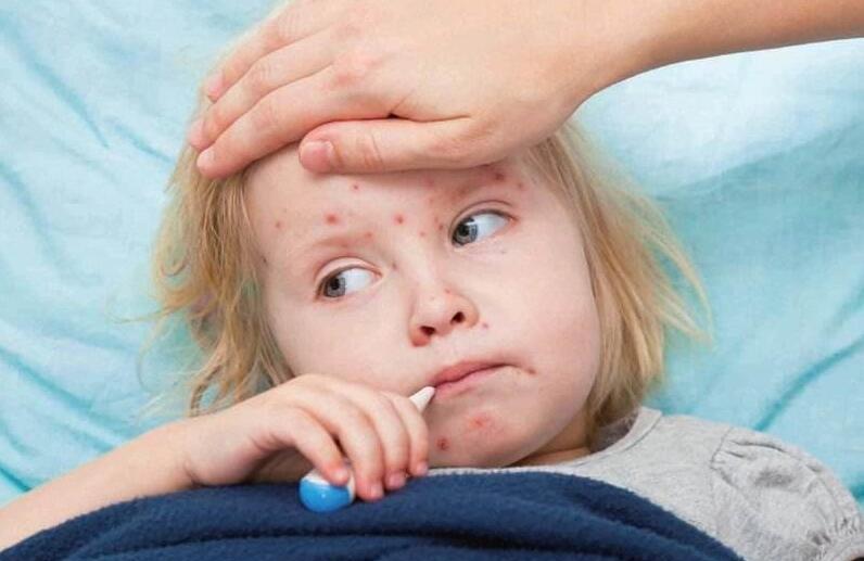 小儿湿疹的治疗方法